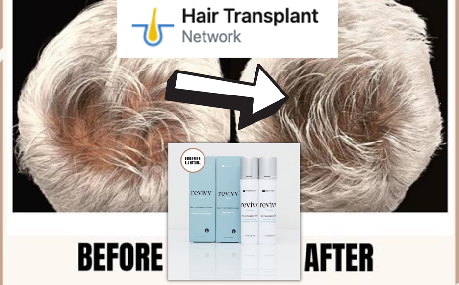 Revivv Featured On Hair Loss Network